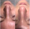 Afbeelding van Micro mesotherapie / Oxygen Power facial of Hydrafacial